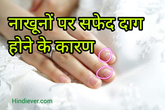 Causes of white spots on nails in hindi